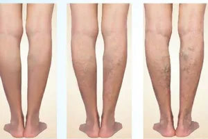 Suy tĩnh mạch có tập thể dục, chạy bộ thoải mái được không?