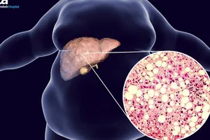 Gan nhiễm mỡ không do rượu, ai dễ mắc?