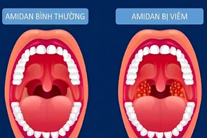 Viêm amidan, làm thế nào để tránh tái phát?