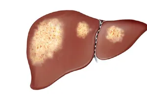 Gan nhiễm mỡ độ 1 có nên uống thuốc bổ gan, giải độc gan?