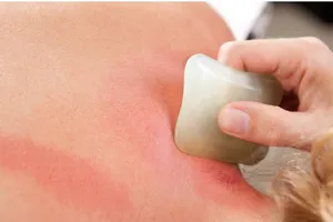 Những người tuyệt đối không được cạo gió, rất nguy hiểm