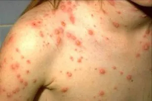 TP.HCM: Giám sát nơi hơn 20 học sinh mắc thủy đậu