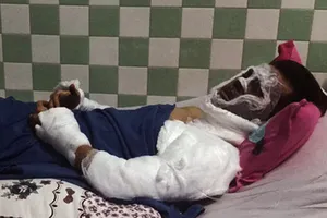 Việt kiều bị tạt a xít ở Quảng Ngãi bị cháy giác mạc