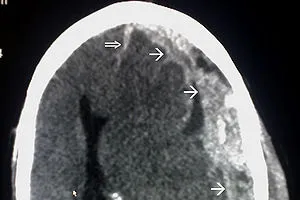 1 Phó công an phường chấn thương sọ não tại quán Karaoke