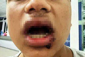 Xác định được nhóm người hành hung, làm gãy 4 cái răng của nam sinh