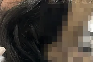 Thanh niên ở Ninh Thuận dùng búa tấn công vào vùng đầu đối phương