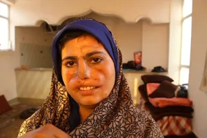 Bi kịch của người phụ nữ bị chồng cắt đứt mũi và môi