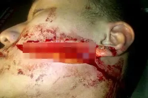 Nam sinh bị rạch mặt giữa đường: Công an Hải Phòng vào cuộc