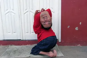 Cảm phục nghị lực của người đàn ông có dị tật đầu lộn ngược