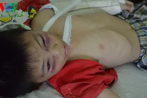 Bé trai bị cha dượng đánh gãy 2 tay chân bị nứt hộp sọ