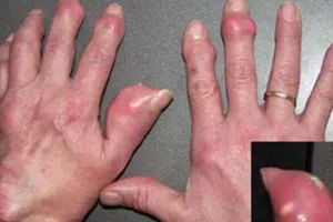 Bị bệnh gout nên ứng phó thế nào?