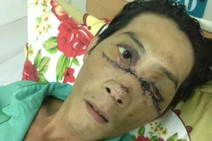 Gãy đôi xương mặt, múc bỏ nhãn cầu trái vì nổ bánh 'xe rùa'