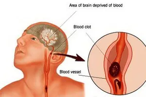 Tai biến mạch máu não: Phòng ngừa và chữa trị
