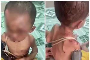 Bé trai hơn 1 tuổi nghi bị bạo hành, người dân trình báo công an