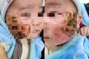 Đắp lá cây chữa viêm da, bé trai bị loét hai bên má