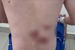 Nam thanh niên mắc giang mai, lở loét hết lưng