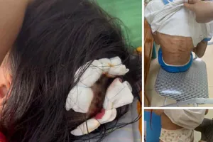 Vụ bé gái lớp 5 bị cha dượng dùng búa đánh vào đầu: Có dấu hiệu của tội giết người