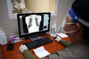 Hình ảnh phổi của bệnh nhân trên phim X-quang tại phòng khám hậu COVID-19.