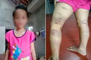 Học sinh lớp 2 bị cô giáo đánh tím đùi vì viết sai chính tả