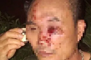 Bảo vệ chung cư bị côn đồ hành hung nhập viện