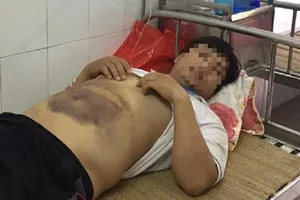 Điều tra vụ bầm tím người sau khi làm việc với công an