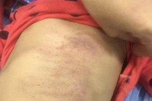 Giám định vết thương bé gái mầm non bầm tím khắp người