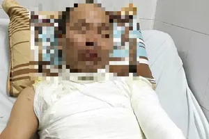 Điều tra vụ cha bị tạt axit trước mặt con gái tại Hà Nội