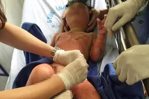 Thông tin mới vụ cô giáo dùng cồn dạy học làm 3 trẻ bỏng nặng