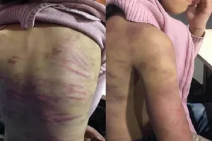 Cơ thể bé gái 12 tuổi với rất nhiều vết thương. Ảnh: GĐCC