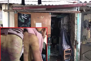 Bé gái 12 tuổi bị bạo hành, mẹ nói 'chỉ muốn dạy dỗ ngoan hơn'