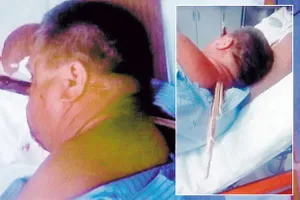 Bị cọc gỗ 38cm đâm xuyên đầu … vẫn sống sót