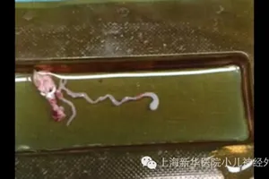 Sán dài 8 cm làm tổ trong não vì thức ăn đường phố