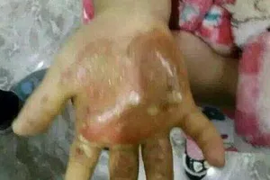 Mẹ đẻ nhúng tay con gái vào nước sôi, rắc muối vào vết thương