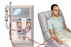 Bệnh nhân chạy thận nhân tạo dễ gặp những rủi ro nào?