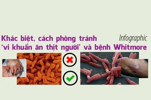 Phân biệt bệnh do ‘vi khuẩn ăn thịt người’ và bệnh whitmore