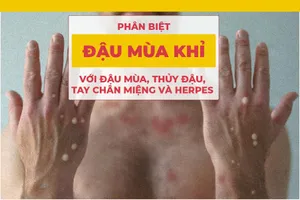 Phân biệt đậu mùa khỉ với đậu mùa, thủy đậu, tay chân miệng và herpes