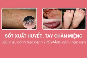 Dấu hiệu cảnh báo bệnh sốt xuất huyết và tay chân miệng trở nặng cần nhập viện 