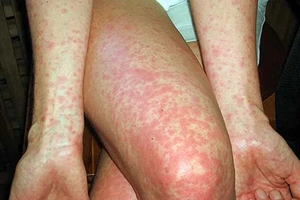 Sởi lành tính vẫn gây chết người như chơi 