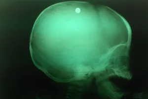 Nghịch súng tự chế, chị gái bắn vào đầu em trai