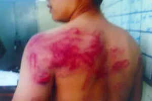 Dân tố bị công an đánh bầm người