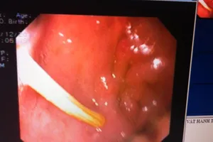 Nội soi lấy tăm đâm vào thành bụng