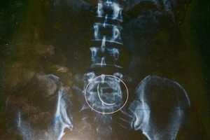 Cảnh cáo bác sĩ để kim trong bụng bệnh nhân chín năm