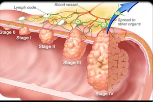 Ung thư ruột già: Có thể kéo dài sự sống