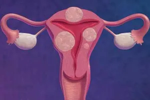 Điều trị u xơ tử cung không cần phẫu thuật