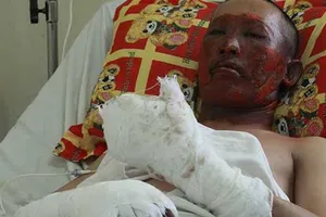 Nổ lò thép, hai công nhân bị bỏng