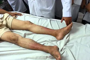 Trị bệnh cho chân bằng sóng cao tần