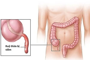 Cấp cứu thành công ngư dân đau ruột thừa trên biển