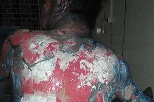 Suýt mất mạng do Đông y ‘vườn’