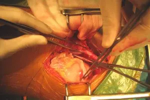 Nhiều bệnh nhân chết vì thiếu nguồn ghép tạng