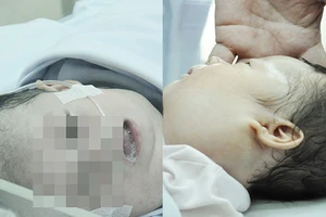 Xót xa 2 bé sơ sinh mắc bệnh hiểm nghèo làm biến dạng khuôn mặt 
